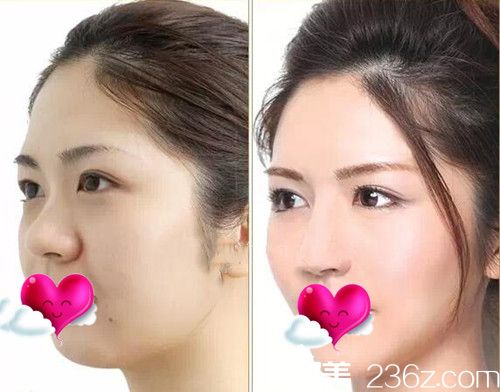 CLINICX無創(chuàng)微整形面部輪廓整形案例效果圖 CLINICX無創(chuàng)微整形面部輪廓整形案例效果圖