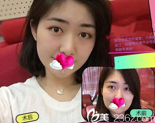 Dr.Kim金鐘明做的埋線提拉效果對比圖 Dr.Kim金鐘明做的埋線提拉效果對比圖