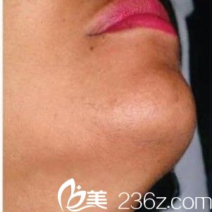 品普拉尼激光無痛脫毛術后效果 品普拉尼激光無痛脫毛術后效果