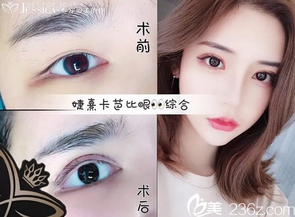 婕熹卡全切雙眼皮+開眼角真人案例 婕熹卡全切雙眼皮+開眼角真人案例