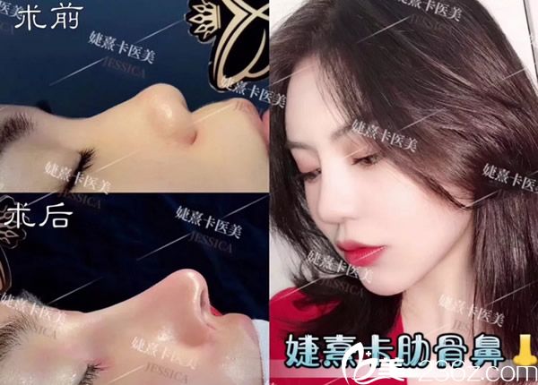 香港婕熹卡自體肋軟骨隆鼻效果案例 香港婕熹卡自體肋軟骨隆鼻效果案例