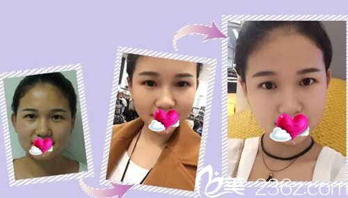 CLINICX無創(chuàng)微整形玻尿酸+案例效果圖