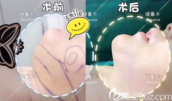 香港婕熹卡雙下巴吸脂效果怎么樣 香港婕熹卡雙下巴吸脂效果怎么樣