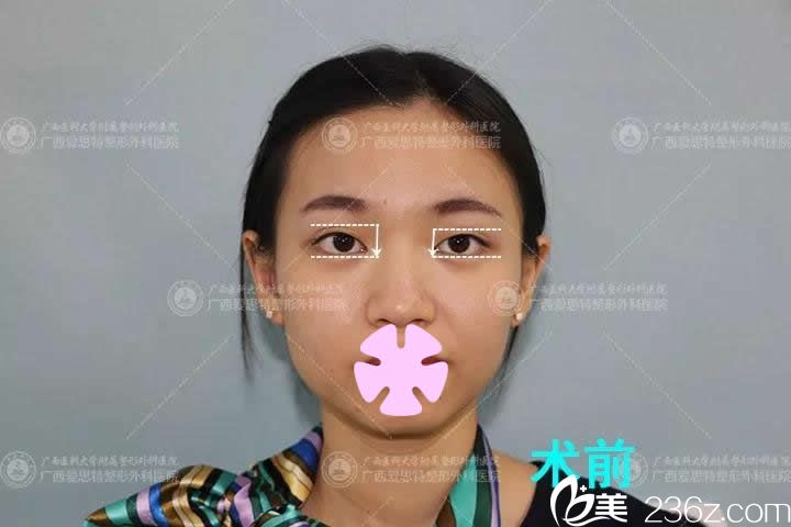 我在南寧愛(ài)思特整形做雙眼皮前的照片 我在南寧愛(ài)思特整形做雙眼皮前的照片