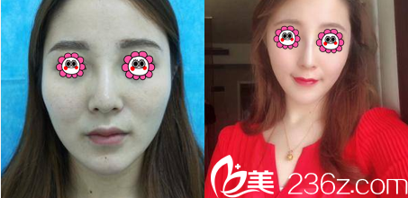 中國(guó)臺(tái)灣京媛隆鼻案例