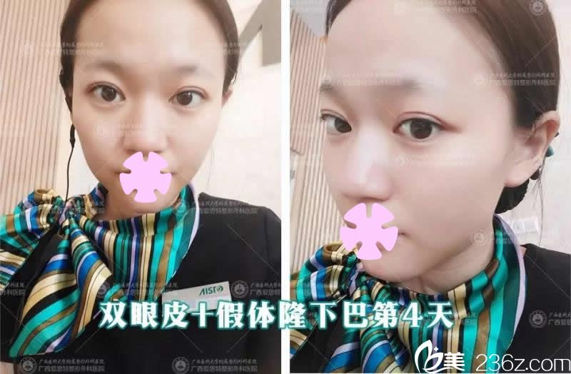 我在南寧愛(ài)思特整形做雙眼皮和假體墊下巴術(shù)后第4天照片 我在南寧愛(ài)思特整形做雙眼皮和假體墊下巴術(shù)后第4天照片