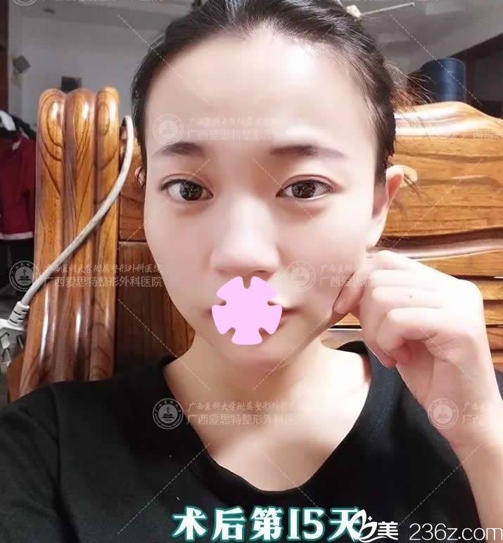 我在南寧愛(ài)思特整形做眼睛和下巴術(shù)后第15天照片 我在南寧愛(ài)思特整形做眼睛和下巴術(shù)后第15天照片