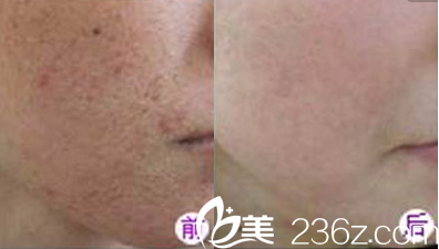 中國臺灣京媛劉賢佐醫(yī)生祛斑案例 中國臺灣京媛劉賢佐醫(yī)生祛斑案例