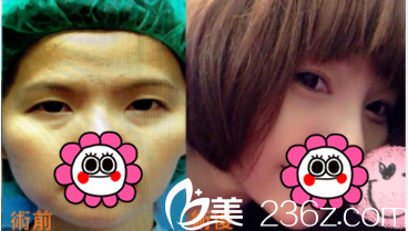 中國臺灣京媛劉賢佐醫(yī)生雙眼皮案例 中國臺灣京媛劉賢佐醫(yī)生雙眼皮案例