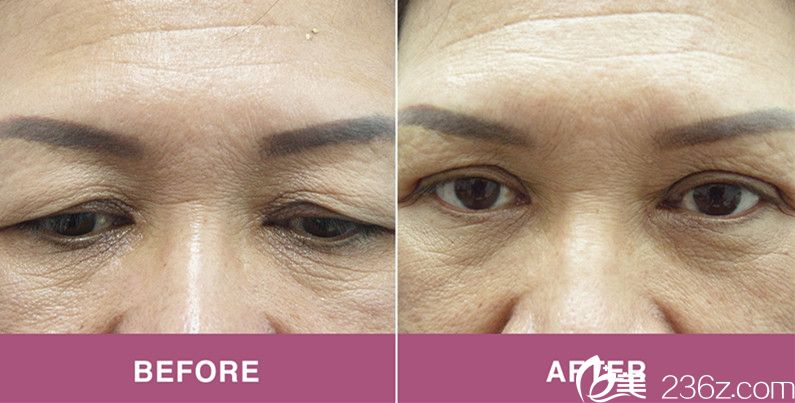 上瞼成形術(shù)前后對(duì)比照 上瞼成形術(shù)前后對(duì)比照