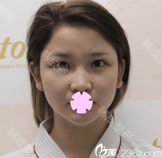 我在南寧韓成整形做眼鼻部整形前的照片 我在南寧韓成整形做眼鼻部整形前的照片