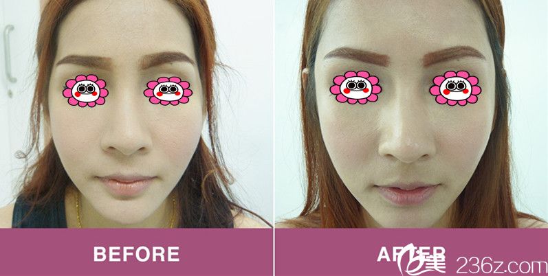 面部脂肪填充效果圖 面部脂肪填充效果圖