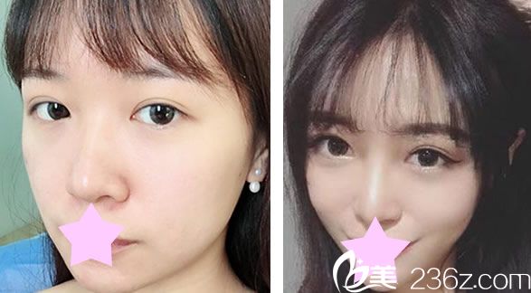 王朝輝瘦臉效果對比圖