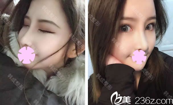 在南寧韓成整形把雙眼皮、隆鼻和瘦臉一起做了，術(shù)后竟然美成這樣