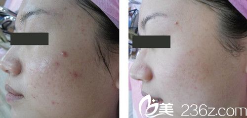 中國臺(tái)灣妮蔻時(shí)尚診所沈文示祛痘案例