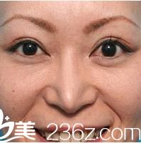 福田慶三鼻部修復手術案例照片 福田慶三鼻部修復手術案例照片