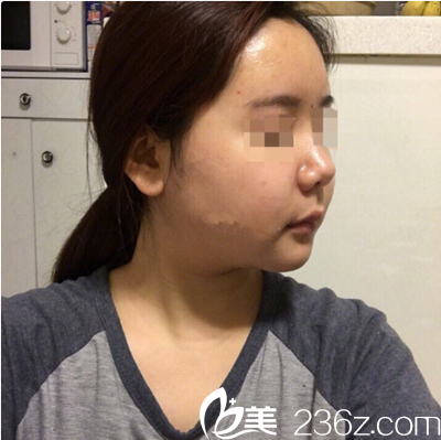 手術(shù)前照片 手術(shù)前照片