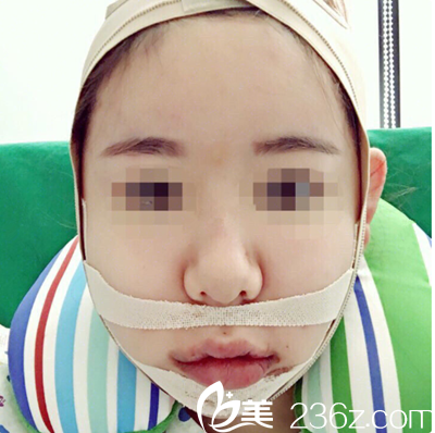 金鐘潤(rùn)輪廓手術(shù)案例 金鐘潤(rùn)輪廓手術(shù)案例