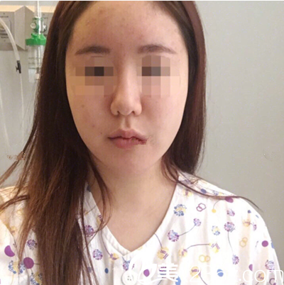 下頜角手術(shù)后20天 下頜角手術(shù)后20天