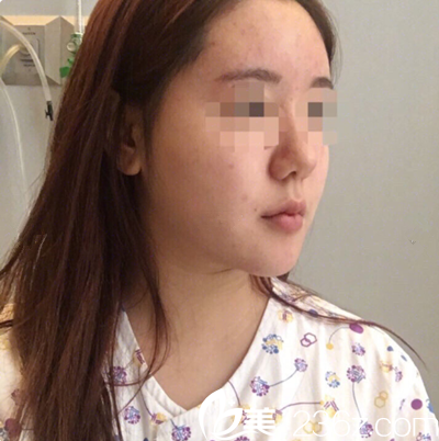 輪廓手術(shù)20天后恢復(fù)效果 輪廓手術(shù)20天后恢復(fù)效果