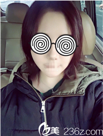 輪廓手術(shù)兩個(gè)月后效果 輪廓手術(shù)兩個(gè)月后效果