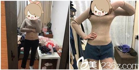 寧波鄞州壹加壹美容醫(yī)院吸脂<span style=