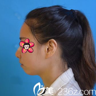 打玻尿酸豐下巴前照片 打玻尿酸豐下巴前照片