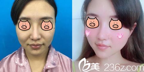 歐陽慧恩注射瘦臉除皺瘦臉案例效果