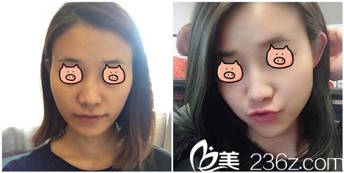 歐陽慧恩主任聚焦超聲波緊膚術(shù)后效果