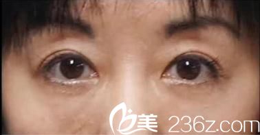 在日本花園美容整形醫(yī)院做了自體脂肪填充祛眼袋，術(shù)后我真的后悔了