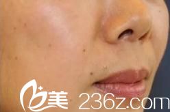 ?日本哪個(gè)醫(yī)院皮秒激光祛斑好?分享一下我在日本花園美容整形醫(yī)院的體驗(yàn)案例