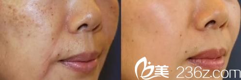 大庭英信醫(yī)生皮秒激光祛斑前后對比