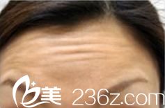 城野醫(yī)生瘦臉除皺注射前 城野醫(yī)生瘦臉除皺注射前