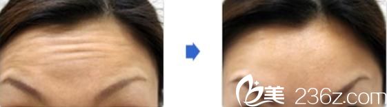 日本城野醫(yī)生醫(yī)療美容醫(yī)院瘦臉除皺注射前后對(duì)比 日本城野醫(yī)生醫(yī)療美容醫(yī)院瘦臉除皺注射前后對(duì)比