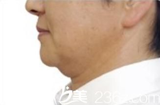 城野親德院長做熱瑪吉緊膚前 城野親德院長做熱瑪吉緊膚前