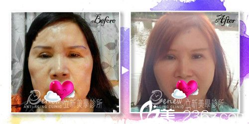 立新美學(xué)診所線雕提升案例