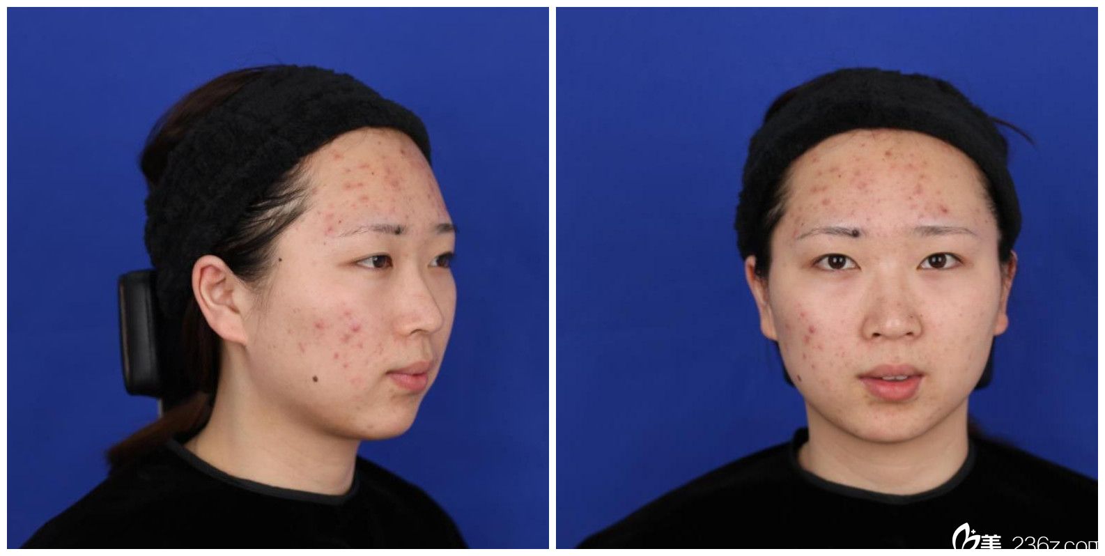 去合肥壹美尚整形做微針美塑前樣子 去合肥壹美尚整形做微針美塑前樣子