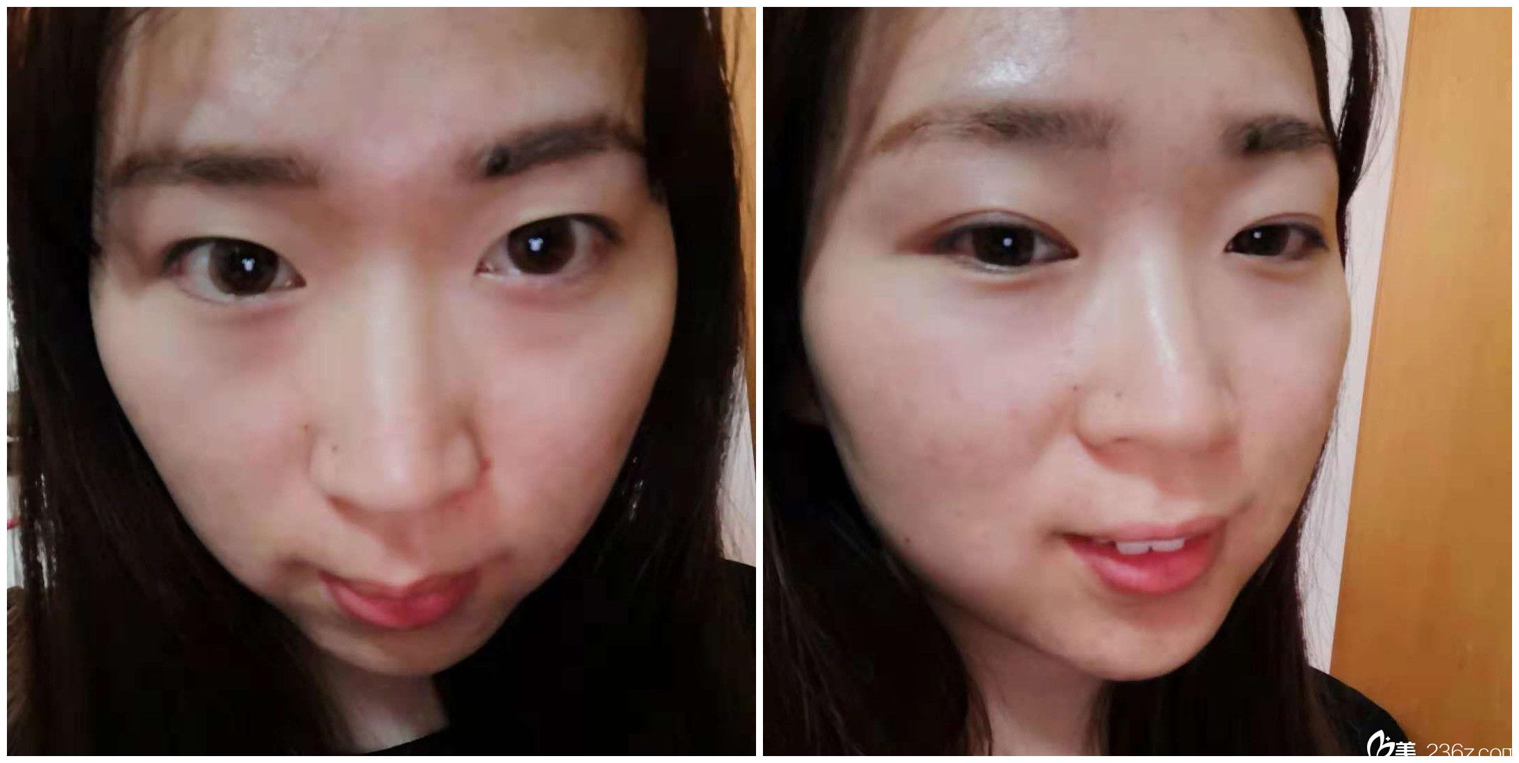 找孫佳佳主任做次微針?biāo)苊篮?4天 找孫佳佳主任做次微針?biāo)苊篮?4天