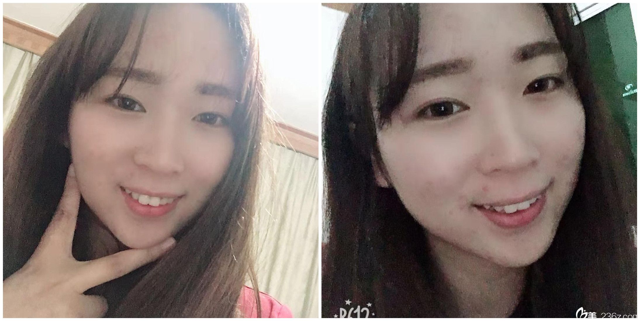 合肥壹美尚整形次微針美塑后30天效果 合肥壹美尚整形次微針美塑后30天效果