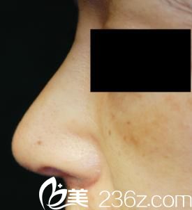 日本酒井整形外科醫(yī)院酒井倫明假體和耳軟骨綜合隆鼻后十天 日本酒井整形外科醫(yī)院酒井倫明假體和耳軟骨綜合隆鼻后十天