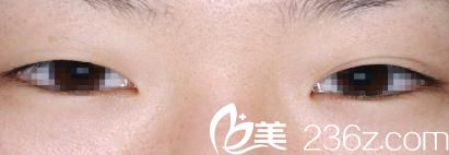 酒井倫明埋線法雙眼皮前睜開眼 酒井倫明埋線法雙眼皮前睜開眼