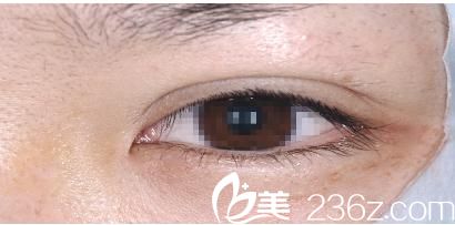 酒井倫明埋線法雙眼皮術(shù)后睜眼 酒井倫明埋線法雙眼皮術(shù)后睜眼