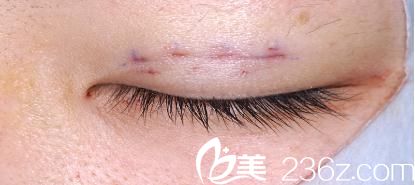 酒井倫明埋線法雙眼皮術(shù)后閉眼 酒井倫明埋線法雙眼皮術(shù)后閉眼