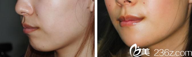 日本酒井形成外科醫(yī)院假體植入墊下巴前后對(duì)比 日本酒井形成外科醫(yī)院假體植入墊下巴前后對(duì)比