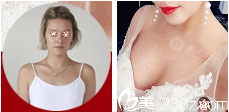 重慶華美豐胸怎么樣