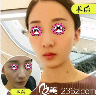 北京壹加壹奧美定/不明注射物取出優(yōu)惠進行中！價格2980元起附案例