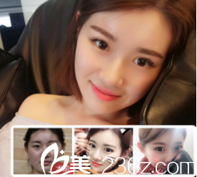 濟(jì)南美蓮全切雙眼皮案例