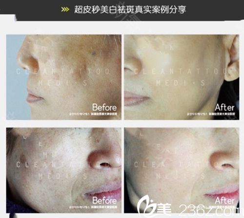 韓國(guó)科琳撻圖皮膚科雙皮秒美白祛斑