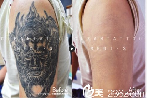  韓國(guó)科琳撻圖皮膚科去紋身