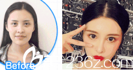 濟(jì)南美蓮假體隆鼻案例